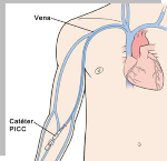 Dibujo del corazón, con las venas y un catéter colocado en la vena